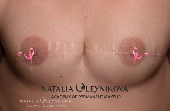 Ареола заживший результат